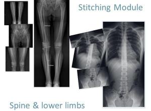 Stitching