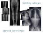 Stitching