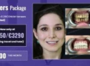 Veneers in Turkey